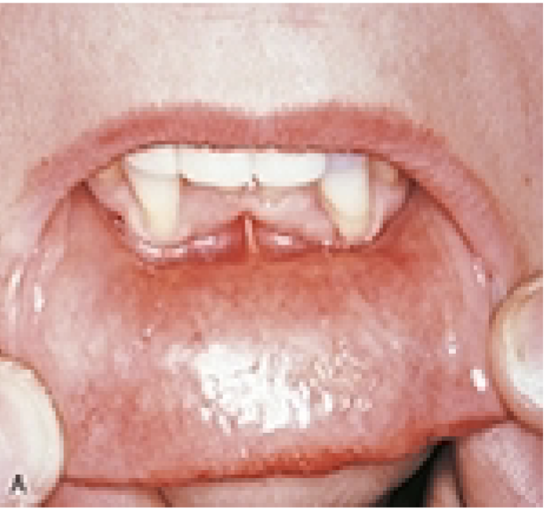 <p>Contact Mucositis</p>
