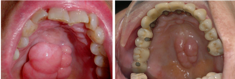 <p>torus palatinus</p>