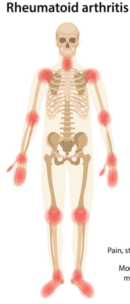 <p>T (usually mild-low grade fever, iridocyclitis, RF+ follows rheumatoid disease) </p>