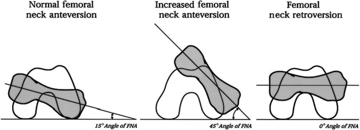 <p>angle btwn femoral neck & condyles</p><ul><li><p>Normal: 10-20 degrees</p></li><li><p>Anteversion: >20 degrees</p><ul><li><p>toe-in gait</p></li></ul></li><li><p>Retroversion: <10 degrees</p><ul><li><p>toe-out gait</p></li></ul></li></ul><p></p>