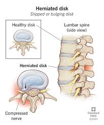 <p>Weakening of the intervertebral disk resulting in protrusion of the nucleus or annulus; may press on the spinal cord.</p>