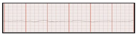 <p>Identify the above waveform:</p><p>a. asystole</p><p>b. monitor malfunction </p><p>c. A fib</p><p>d. V fib</p>
