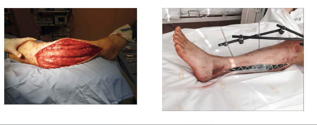 <ul><li><p>devastating lower extremity condition where compt pressure rises to a level that decreases perfusion of leg </p><ul><li><p>blood flow & nerve signaling cut off from inflammation</p></li></ul></li><li><p>may lead to irreversible muscle & neurovascular damage</p></li><li><p>treatment = emergent fasciotomy</p></li></ul><p></p>