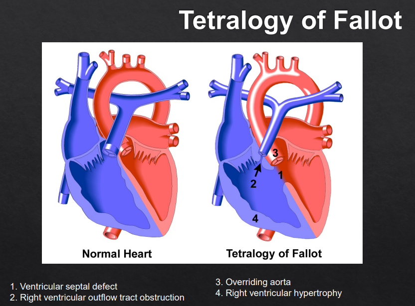 <p>Tetralogy of Fallot/TOF (R2)</p>