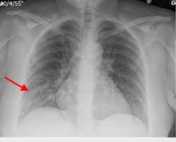 <p><strong>Infiltrate </strong></p>