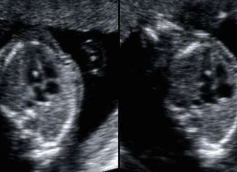 <ul><li><p><span style="background-color: transparent;">Microcalcification in papillary muscle</span></p></li><li><p><span style="background-color: transparent;">Can be in LV or RV</span></p><ul><li><p><span style="background-color: transparent;">EIF seen in RV is more often associated w/ aneuploidy</span></p></li></ul></li><li><p><span style="background-color: transparent;">Normal variant if seen on its own</span></p><ul><li><p><span style="background-color: transparent;">If seen w/ other anomalies → increased risk of aneuploidy</span></p></li></ul></li></ul><p></p>