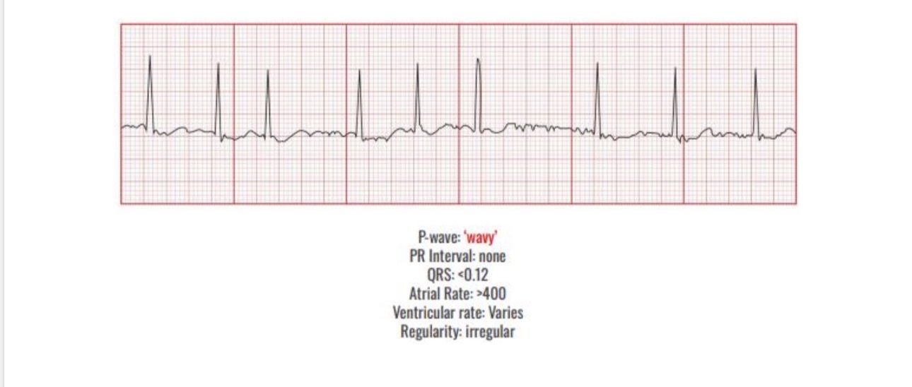 <p>Causes</p><p>Heart disease </p><p><span><span>-Pulmonary Disease</span></span></p><p><span><span>-Stress</span></span></p><p><span><span>-Alcohol</span></span></p><p><span><span>-Caffeine</span></span></p><p></p><p><span><span>Interventions </span></span></p><p><span><span>Fix the cause</span></span></p><p><span><span>Cardioversion</span></span></p><p><span><span>-Antiarrhythmics: amiodarone</span></span></p><p><span><span>-Beta blockers: metoprolol</span></span></p><p><span><span>-Surgery: ablationRMIT Classificati</span></span></p>