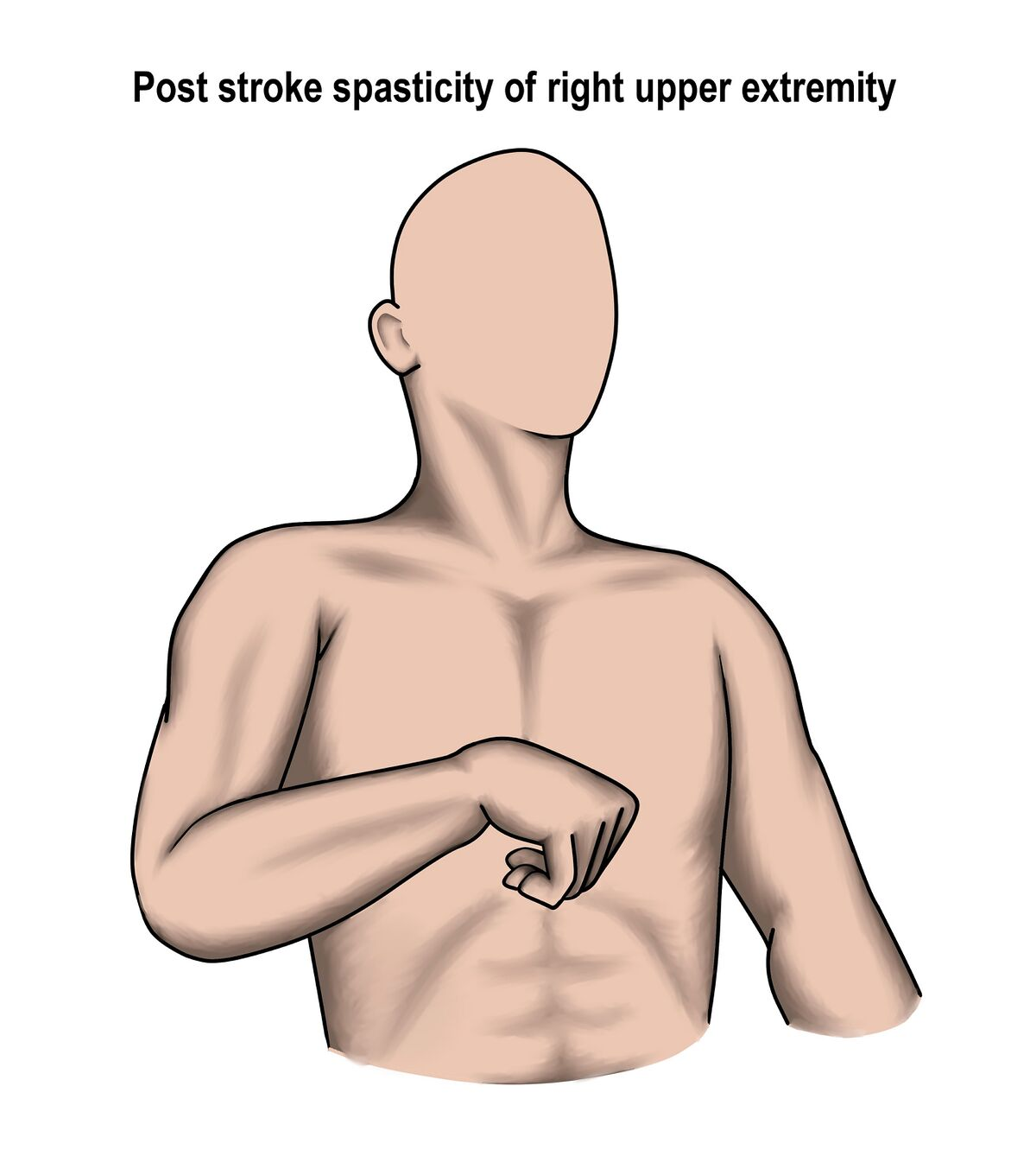 <p>CHICKEN DANCE </p><ul><li><p>Shoulder Retraction and downward rotation</p></li><li><p>Humeral adduction, IR, depression</p></li><li><p>Elbow and wrist flexion/adduction</p></li><li><p>Forearm Pronation</p></li><li><p>Hand/finger flexion, clenched/adducted thumb in palm</p></li></ul><p></p>