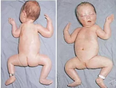 <p>Bij een pasgeborene zie je hypotonie (=verlaagde spiertonus) als een “floppy infant”: het hoofd valt naar één kind en de armen en benen liggen in kikkerhouding.</p><p>Hypotonie is niet hetzelfde als spierzwakte!</p>