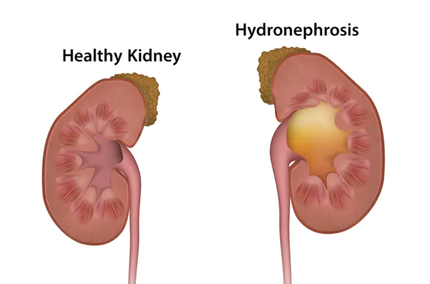 <p><span>Hydronephrosis</span></p>
