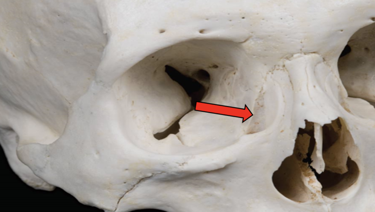 <p><span><strong>Identify the bone marking indicated by the pointer.</strong></span></p>