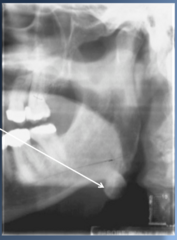 <p>What tumor is this?</p>