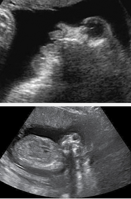 <ul><li><p>Absence of the brain and cranial vault</p></li></ul><ul><li><p>Buldging fetal orbits, giving it a frog like appearence. </p></li></ul><p></p>