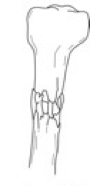 <p>Comminuted Fracture</p>