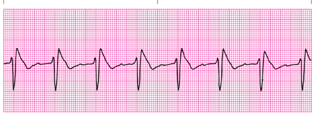 <p>QRS?</p>