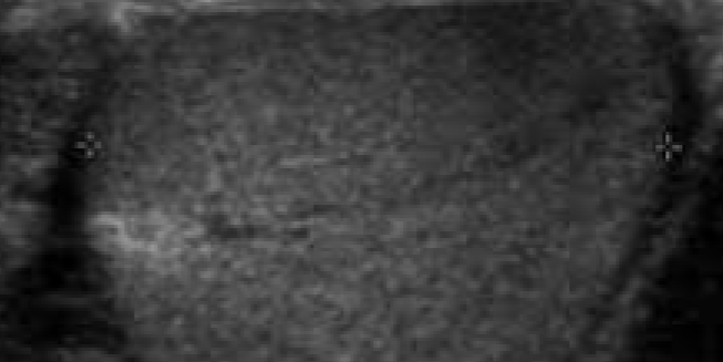 <p>Similar or uniform echo pattern</p>