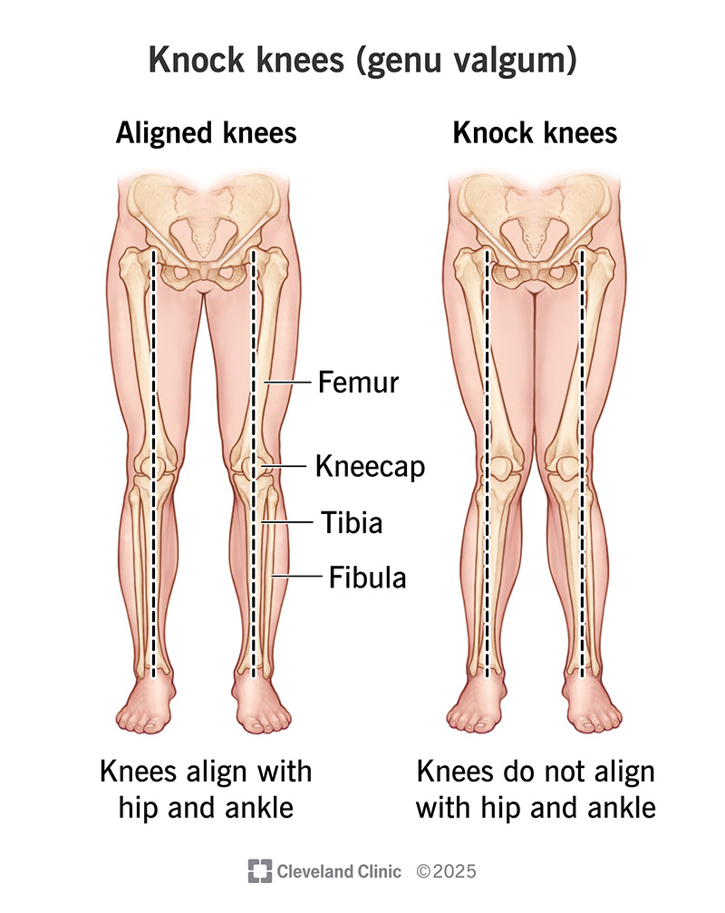 <p>Genu = knee</p><p>Valgum = angled outward (referring to the distal section of a limb)</p><p></p><p>Called knock-knees</p><ul><li><p>when knees touch together, causing the legs/feet to be angled outward</p></li></ul><p></p>