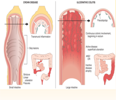 <p>HALLMARK SYMPTOMS:</p><p>-abdominal pain RLQ</p><p>-fevers</p><p>-weight loss</p><p>**Crohn's is more likely to present with non-bloody diarrhea compared to UC</p><p>"skip lesions" with a normal section of bowel between diseased sections</p><p>•Fistula and stricture development</p><p>Noncaseating granulomas (macrophages, with/without multinucleate giant cells).</p>
