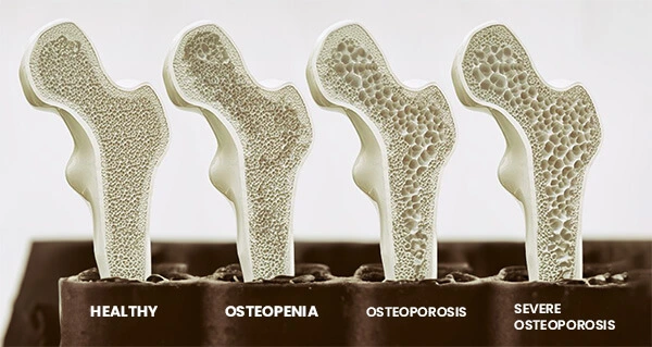 <p>Fragile porous bone condition with high fracture risk, corresponding to a T-score of $$-2.5$$ or lower.</p>