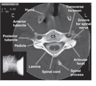 <p>What spinal structures are best visualized in the axial/transverse CT plane?</p>