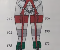 <p><span>Calculate the ankle / brachial index (ABI) using the pressure measurements in the image:<br><br>A. Rt: 174/162 and Lt: 176/158<br><br>B. Rt: 174/158 and Lt: 176/162<br><br>C. Rt: 174/162 and Lt: 176/162<br><br>D. Rt: 178/158 and Lt: 172/162</span></p>