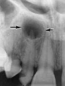 <p>Radiographic Density : less dense tissue (e.g. pulp, periapical lesions)</p>