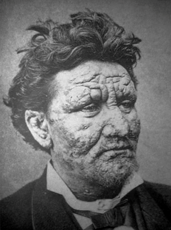 <p>Causative Agent: Mycobacterium leprae (Rod-shaped acid-fast bacterium)<br>Symptoms/Signs: Skin lesions, ulcers, pain, muscle weakness, blindness.</p>