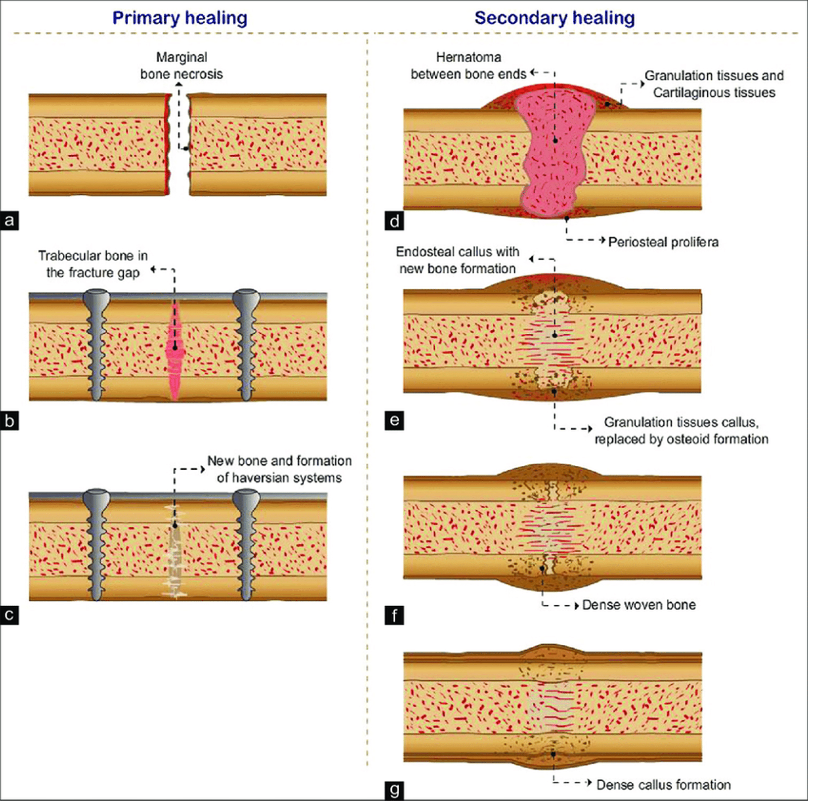 <p>Secondary Fracture healing</p>