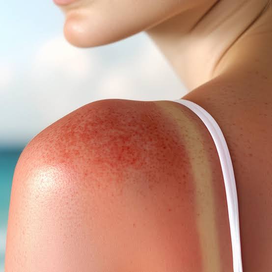 <p>Sonnenbrand (Dermatitis Solaris)</p>