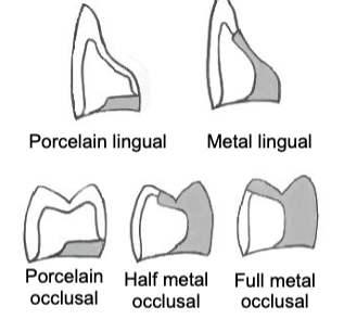 <p>Halfway down the lingual incline of the facial cusp</p>