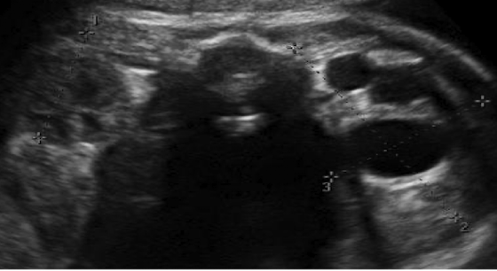<p>kidney tissue is replaced by multiple cysts of varying size and no normal renal tissue </p>