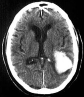 <p>Intraparenchymal hemorrhage </p>