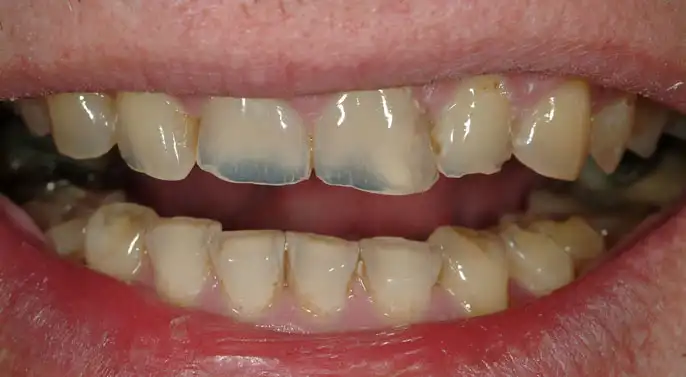 <p>Thinning of the enamel as seen on tooth 8 and 9 is most likely caused by:</p>