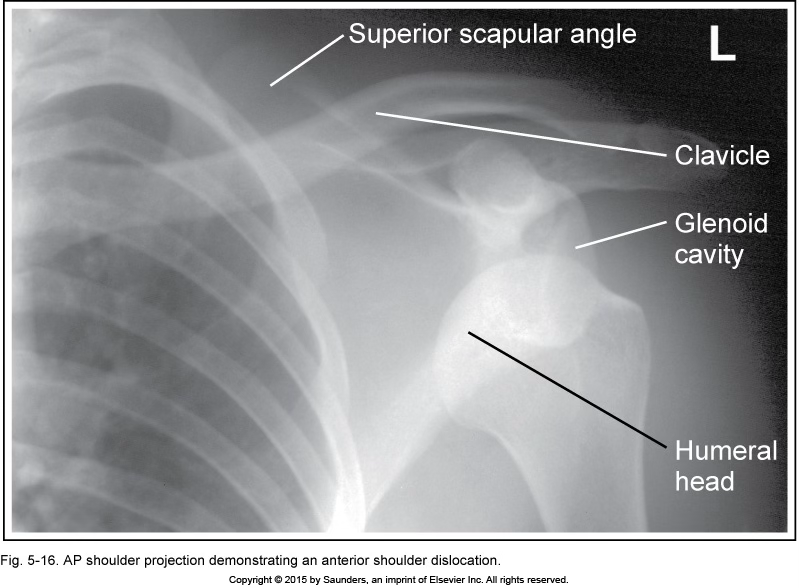 <p>AP shoulder (dislocation)</p>