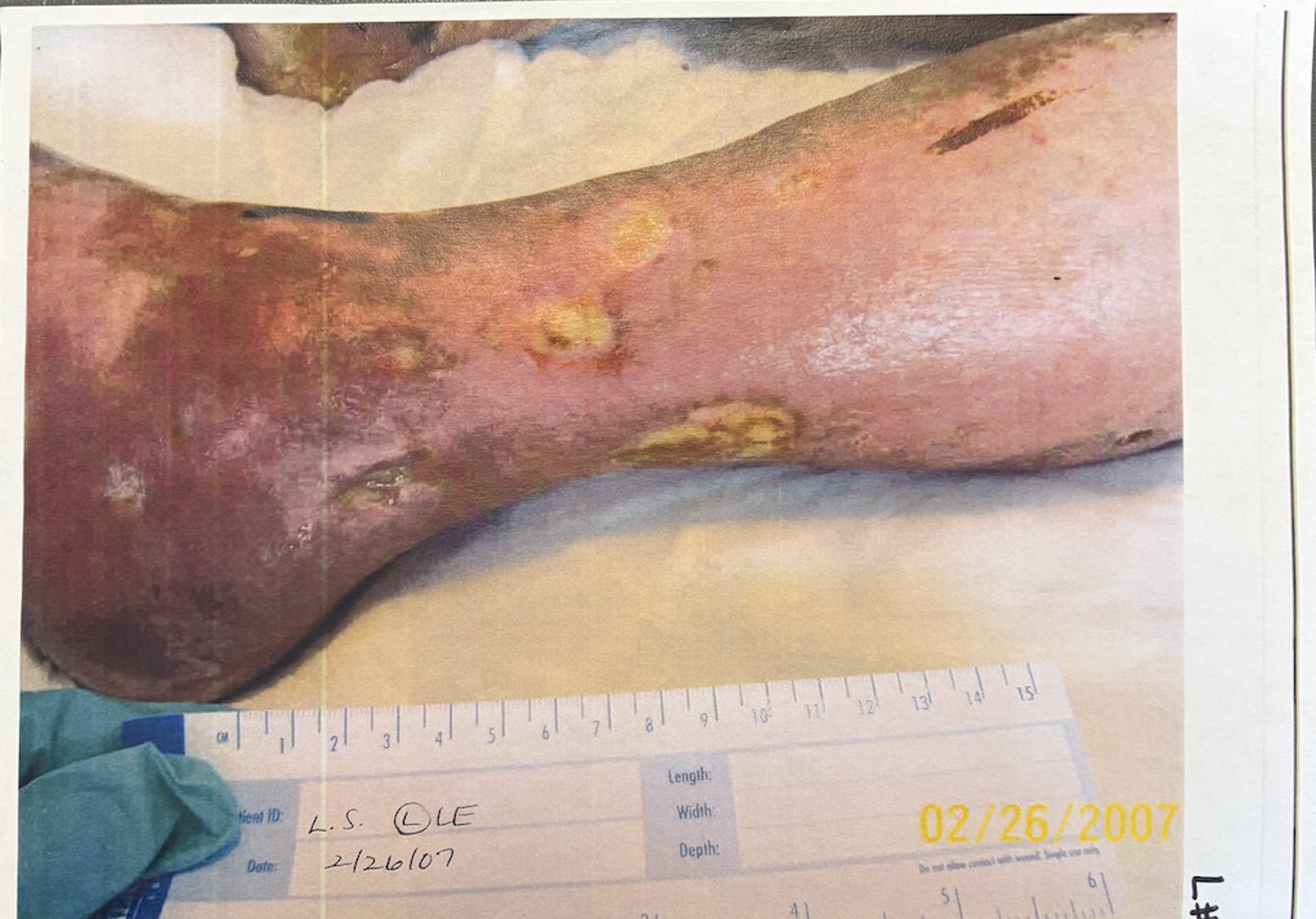 <p>how do you care for this wound.</p>