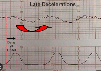 <p><span style="line-height: 20.85px;"><span>onset, nadir, and recovery occur </span></span><span style="line-height: 23.1667px;"><u><span>after</span></u><span> </span></span><span style="line-height: 20.85px;"><span>the beginning, peak and ending of the ctxn, respectively. It suggests </span></span><span style="line-height: 23.1667px;"><u><span>utero-placental insufficiency</span></u></span><span style="line-height: 20.85px;"><span> or decreased blood flow to fetus. </span></span></p><p><span style="line-height: 20.85px;"><span>Nurse action: </span></span><span style="line-height: 23.1667px;"><mark data-color="purple" style="background-color: purple; color: inherit;"><span>immediately change PT position to lateral, O2, IV</span></mark></span></p>