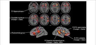 <p>An MRI technique used by Mechelli et al. (2004) to show that bilinguals have higher gray matter density correlating with proficiency and AoA.</p>