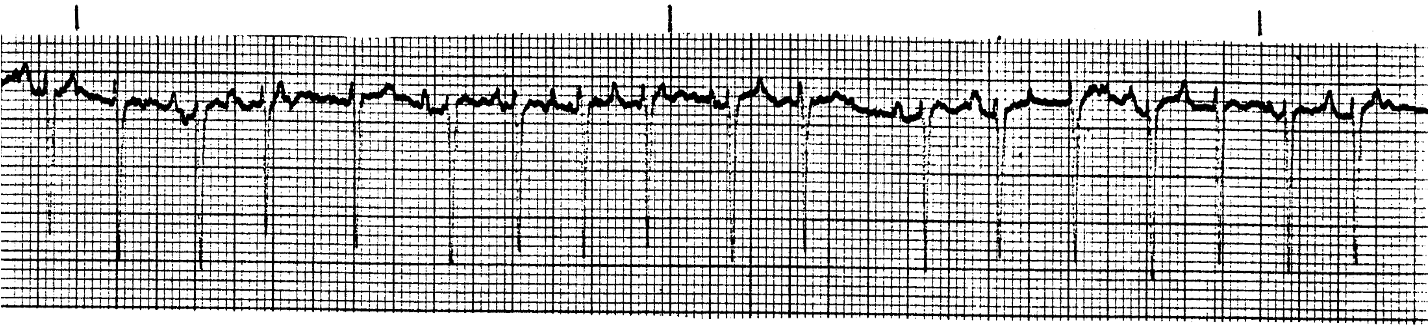 <p>What ECG is this? </p>
