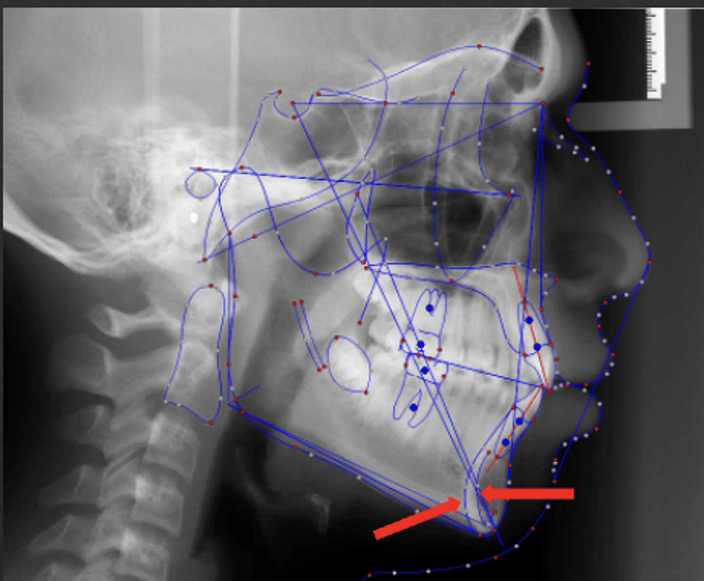<p>which anatomical landmark:</p><p>- The internal and external aspects of the symphysial border</p><p>- Used to superimpose the mandible</p>