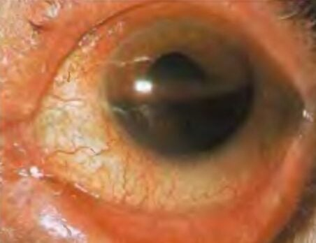 <p>Blood in the anterior chamber of the eye, which may cover part or all of the iris </p><p>-Dx: orbital CT if indicated, ophthalmology consult </p><p>-Tx: elevate head at night at 30 degrees, Tylenol for pain, NO NSAIDs</p>