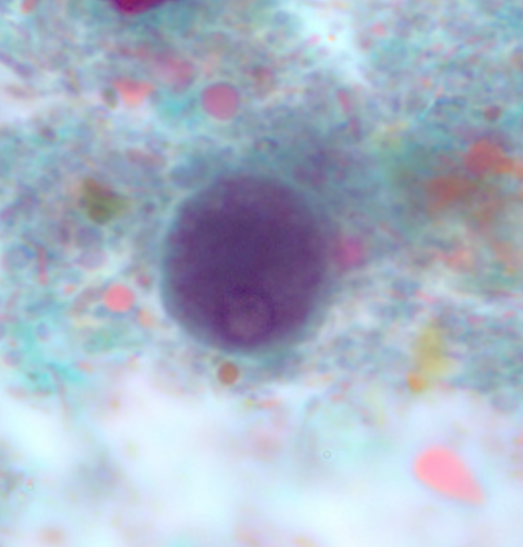 <ol><li><p>Entamoeba polecki</p></li><li><p>Trophozoite</p></li></ol><p></p>