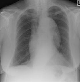 <p>the included image has an example of a thoracic abnormality; what is it?</p>