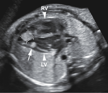 <p>Echogenic tumor(s) within the myocardium of the heart</p>