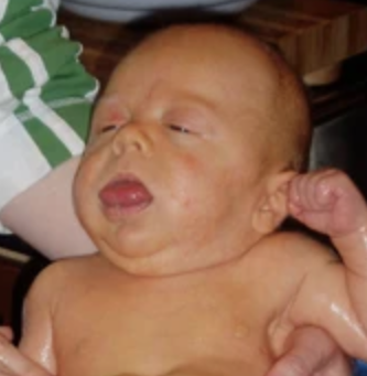 <p>What term would you use to describe this patient's tongue?</p><p>a) Macrodontia</p><p>b) Malocclusion</p><p>c) Macroglossia</p><p>d) Microglossia</p>