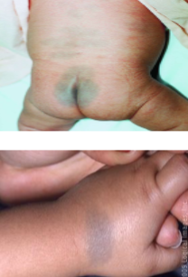 <p>mongolian spots vs. congenital melanocytic nevi</p>