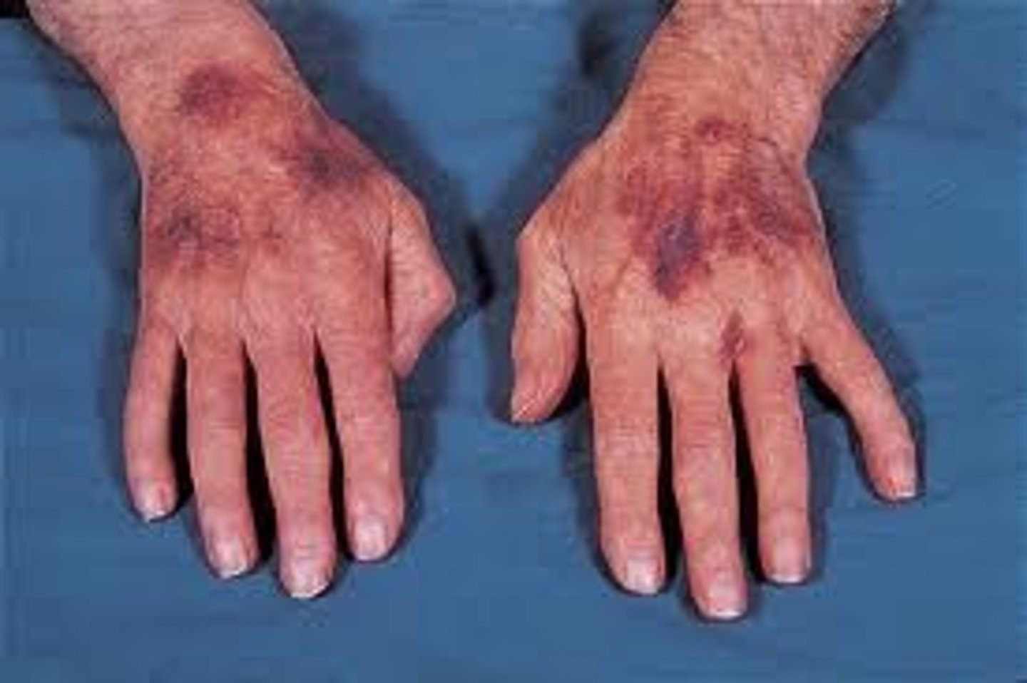 <p>Dark, purplish, bruise-like spots that rapidly expand, becoming hardened and turning into black, necrotic (dying) eschars</p><p>Sepsis Indicators: High fever, chills, and extremely low blood pressure (shock).</p>