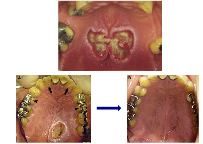 <p>nectrotizing sialometaplasia </p>