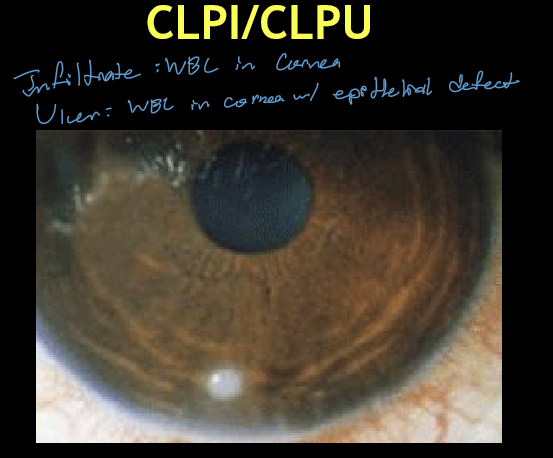 <ul><li><p>Type III hypersensitivity reaction</p></li><li><p>Triggered by excessive Staphylococcal colonization on soft contact lenses</p></li><li><p>Essentially marginal keratitis in a contact lens wearer</p></li><li><p>Sterile inflammatory process, not a primary infection</p></li></ul><p></p>