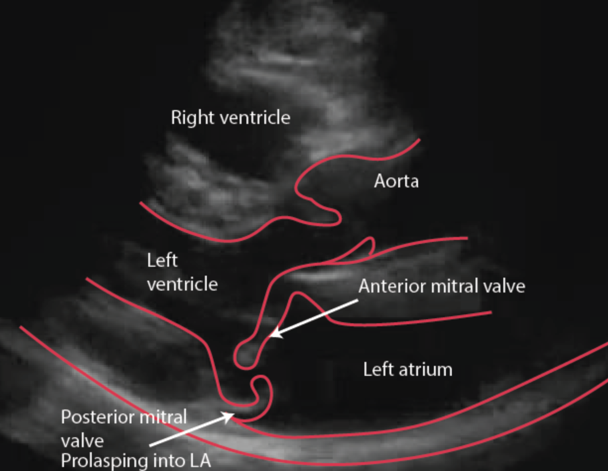 <p>Posterior displacement of any porIon of the MV leaflets beyond the MV annular plane during ventricular systole</p>