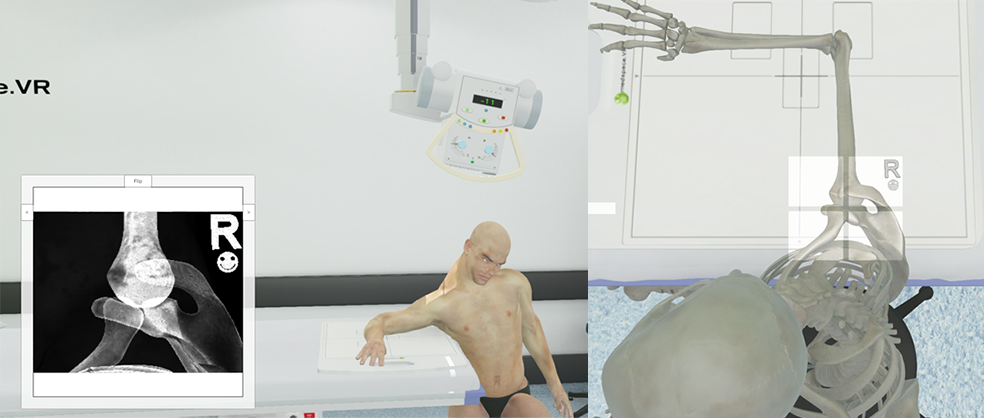 <p>0-15° down humerus depending on flexibility of patient </p>